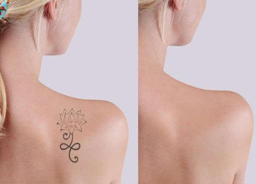 Tattoo Removal Tattoo Removal