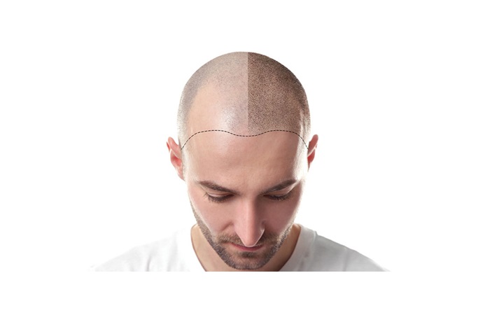 DHI Hair Transplant DHI Hair Transplant